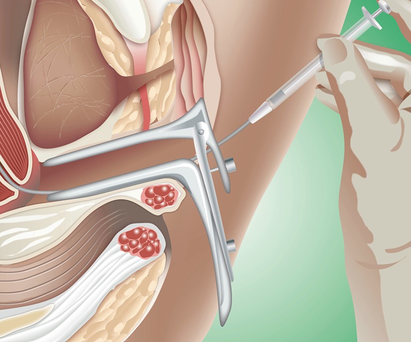 img-crad-inseminacao-artificial-ou-intrauterina-iiu