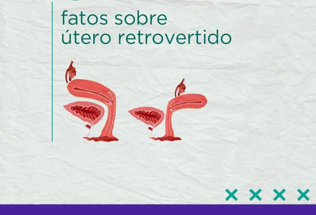 utero-retrovertido-dra-isabela-siqueira-clinica-reproducao-humana-fiv-fertilizacao-in-vitro-dourados-ms